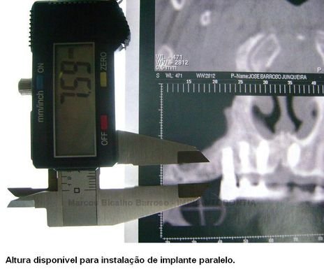 REGIÃO 15: Altura disponível para instalação de implante paralelo.