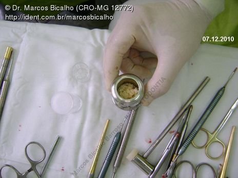 Técnica de Summers com Uso de Prp - Implantes 14,15,16 - Parte Ii - Instalação dos Implantes