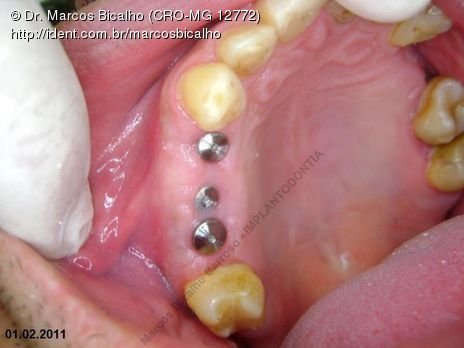 Sutação 55 dias após cirurgia.