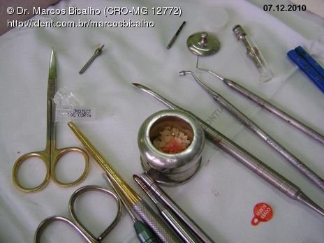 Técnica de Summers com Uso de Prp - Implantes 14,15,16 - Parte Ii - Instalação dos Implantes