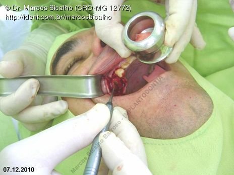 Técnica de Summers com Uso de Prp - Implantes 14,15,16 - Parte Ii - Instalação dos Implantes