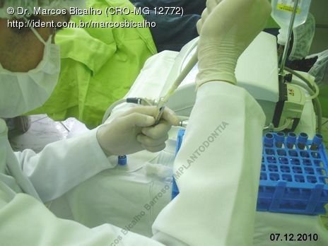 Técnica de Summers com Uso de Prp - Implantes 14,15,16 - Parte Ii - Instalação dos Implantes