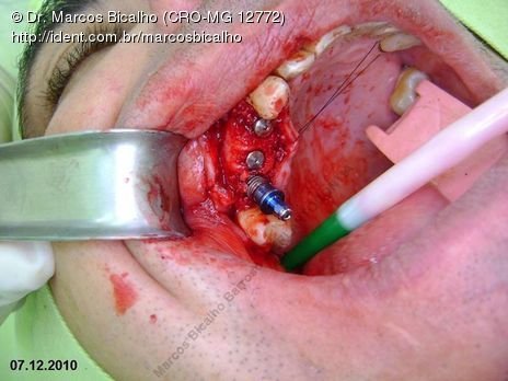 Técnica de Summers com Uso de Prp - Implantes 14,15,16 - Parte Ii - Instalação dos Implantes