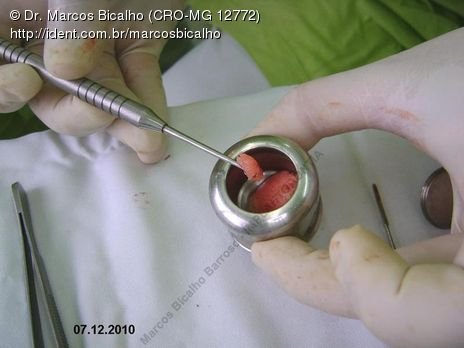 Técnica de Summers com Uso de Prp - Implantes 14,15,16 - Parte Ii - Instalação dos Implantes