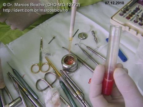 Técnica de Summers com Uso de Prp - Implantes 14,15,16 - Parte Ii - Instalação dos Implantes