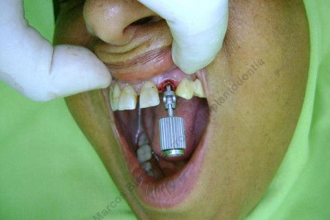 Exodontia Minimamente Traumática com Extrator Neodent + Instalação Imediata de Implante Hexágono Interno, Sem Carga.