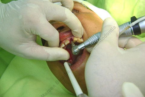 Exodontia Minimamente Traumática com Extrator Neodent + Instalação Imediata de Implante Hexágono Interno, Sem Carga.