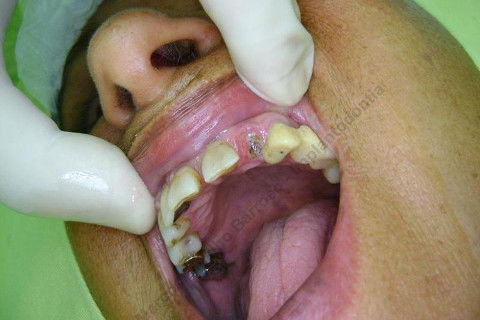 Exodontia Minimamente Traumática com Extrator Neodent + Instalação Imediata de Implante Hexágono Interno, Sem Carga.