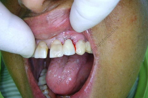 Uma adesiva provisória...