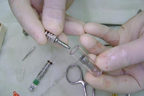 Exodontia Minimamente Traumática com Extrator Neodent + Instalação Imediata de Implante Hexágono Interno, Sem Carga.