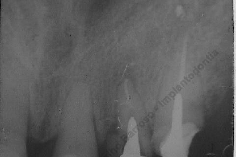 Exodontia Minimamente Traumática com Extrator Neodent + Instalação Imediata de Implante Hexágono Interno, Sem Carga.