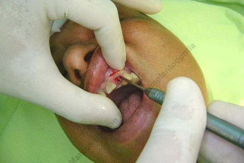 Usando o periótomo...