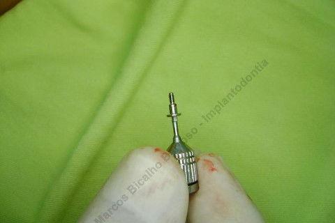 Exodontia Minimamente Traumática com Extrator Neodent + Instalação Imediata de Implante Hexágono Interno, Sem Carga.