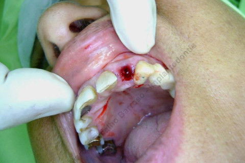 Exodontia Minimamente Traumática com Extrator Neodent + Instalação Imediata de Implante Hexágono Interno, Sem Carga.