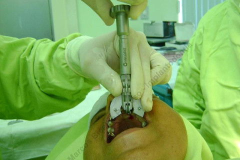 Girando lentamente, enquanto aquele cabo de aço vai tracionando a raiz...