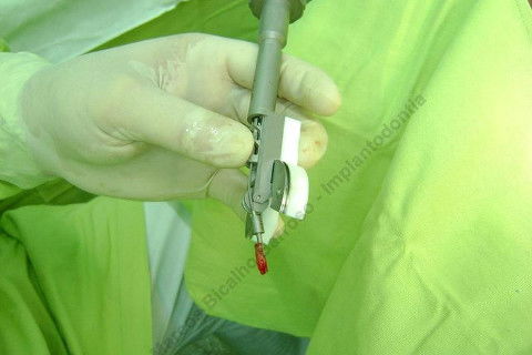 Exodontia Minimamente Traumática com Extrator Neodent + Instalação Imediata de Implante Hexágono Interno, Sem Carga.