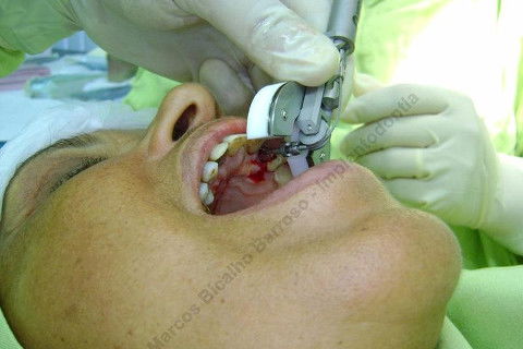 Exodontia Minimamente Traumática com Extrator Neodent + Instalação Imediata de Implante Hexágono Interno, Sem Carga.