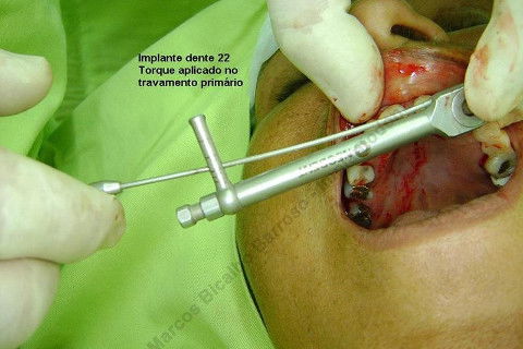 Torque um pouco maior que 20 N, insufiente para carga imediata. Abortamos este procedimento e sepultamos o implante até a sua osseointegração, uma espera de 4 meses.