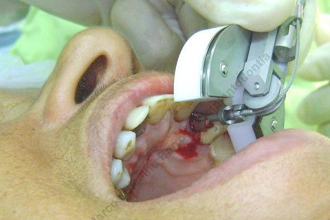 Extração com muita facilidade, sem traumatismo ósseo, principalmente na tábua óssea vestibular.