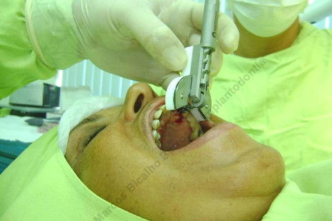 Exodontia Minimamente Traumática com Extrator Neodent + Instalação Imediata de Implante Hexágono Interno, Sem Carga.