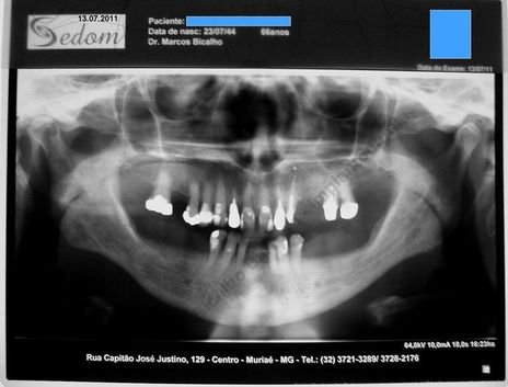 Exodontia Minimamente Traumática com Extrator Neodent + Instalação Imediata de Implante Hexágono Interno, Sem Carga.