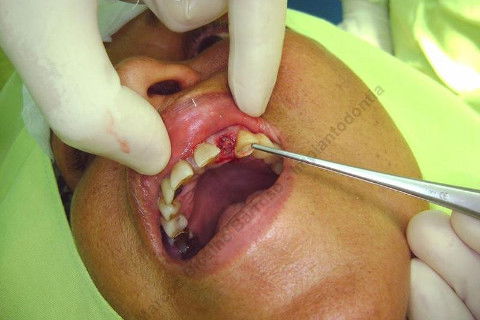 Removendo o fragmento da raiz fraturada...