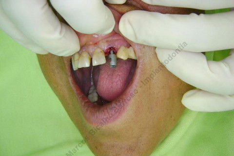 Exodontia Minimamente Traumática com Extrator Neodent + Instalação Imediata de Implante Hexágono Interno, Sem Carga.