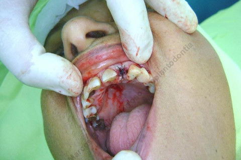 Exodontia Minimamente Traumática com Extrator Neodent + Instalação Imediata de Implante Hexágono Interno, Sem Carga.