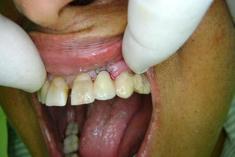 Exodontia Minimamente Traumática com Extrator Neodent + Instalação Imediata de Implante Hexágono Interno, Sem Carga.