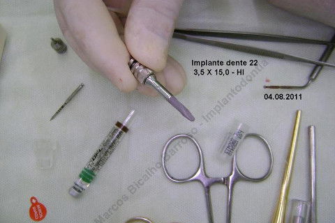 Exodontia Minimamente Traumática com Extrator Neodent + Instalação Imediata de Implante Hexágono Interno, Sem Carga.