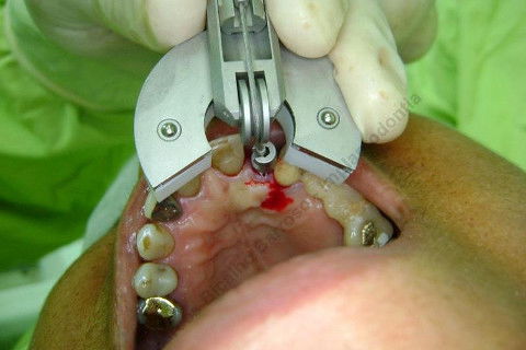 Extrator posicionado...