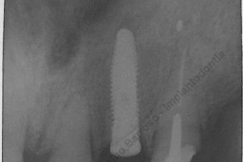 Exodontia Minimamente Traumática com Extrator Neodent + Instalação Imediata de Implante Hexágono Interno, Sem Carga.