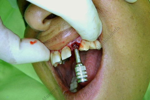 Exodontia Minimamente Traumática com Extrator Neodent + Instalação Imediata de Implante Hexágono Interno, Sem Carga.