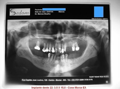 Exodontia Minimamente Traumática com Extrator Neodent + Instalação Imediata de Implante Hexágono Interno, Sem Carga.