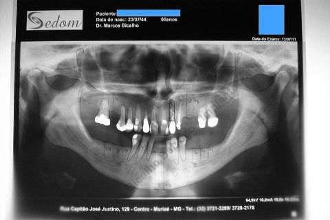 Exodontia Minimamente Traumática com Extrator Neodent + Instalação Imediata de Implante Hexágono Interno, Sem Carga.