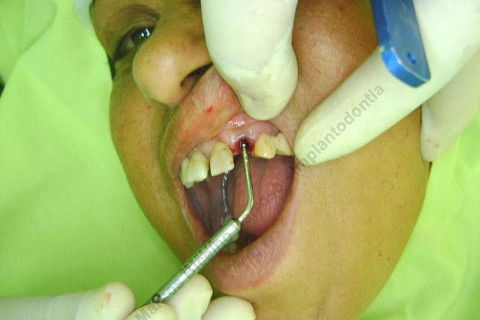 Conferindo profundidade do alvéolo com sonda de titânio. Neste caso, 11mm do ápice do alveólo até rebordo ósseo e 13mm até bordo gengival. Portanto, considerando implante de 15mm de comprimento, conseguimos apenas 4mm de fixação em osso 
