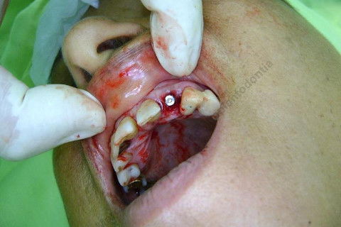 Exodontia Minimamente Traumática com Extrator Neodent + Instalação Imediata de Implante Hexágono Interno, Sem Carga.