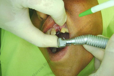 Iniciando a exodontia atraumática. Preparando a raiz com broca do tipo Peeso (kit extrator), para fixar o 