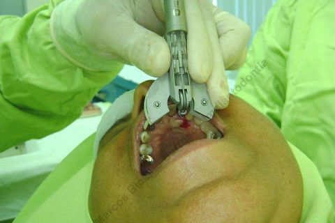 Exodontia Minimamente Traumática com Extrator Neodent + Instalação Imediata de Implante Hexágono Interno, Sem Carga.