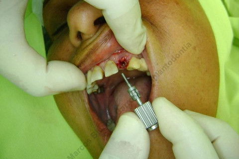 Exodontia Minimamente Traumática com Extrator Neodent + Instalação Imediata de Implante Hexágono Interno, Sem Carga.