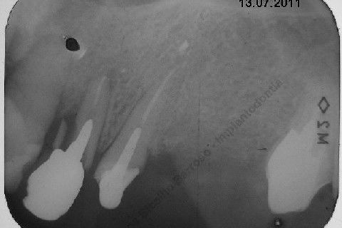 Exodontia Minimamente Traumática com Extrator Neodent + Instalação Imediata de Implante Hexágono Interno, Sem Carga.