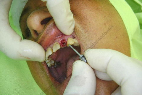 Provando a adaptação de alguns tipos de macho de rosca, de acordo com o diâmetro e profundidade do preparo.