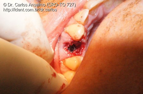 Reabilitação de Elemento Dental Fraturado com Implante Imediato e Provisório.