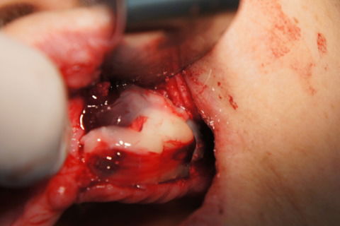 Benefícios do L-Prf na Implantodontia