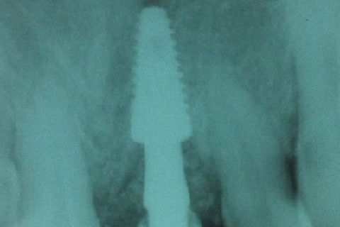 RAIO X APÓS 1 SEMANA