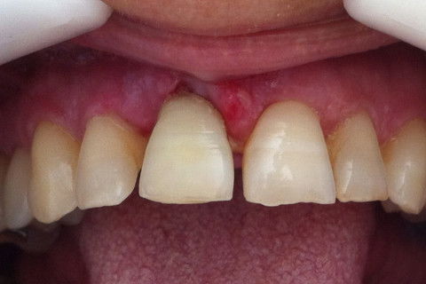 ASPECTO CLÍNICO COM 1 SEMANA