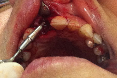 COMPONENTE PROTÉTICO 4,5 mm