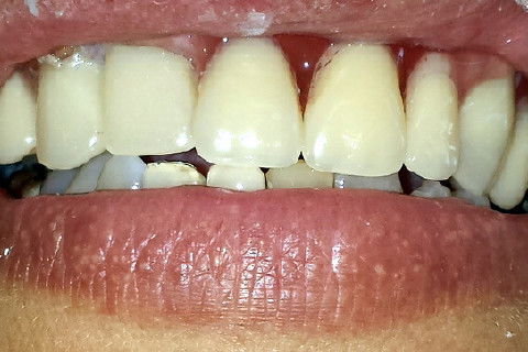 Clareamento de Dente Não Vital