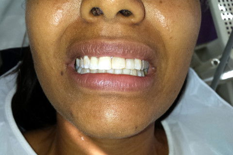 Clareamento de Dente Não Vital