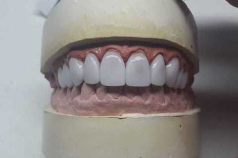 Reabilitação com Facetas em Porcelana Emax Fresadas